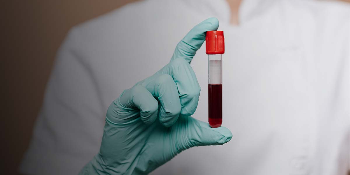 Reuma en la sangre Descubre qué es la prueba de factor reumatoideo